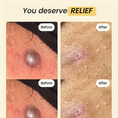 Velisee  Drawing Salve – Natural Beeswax & Propolis Balm for Painful Bumps & Irritated Skin